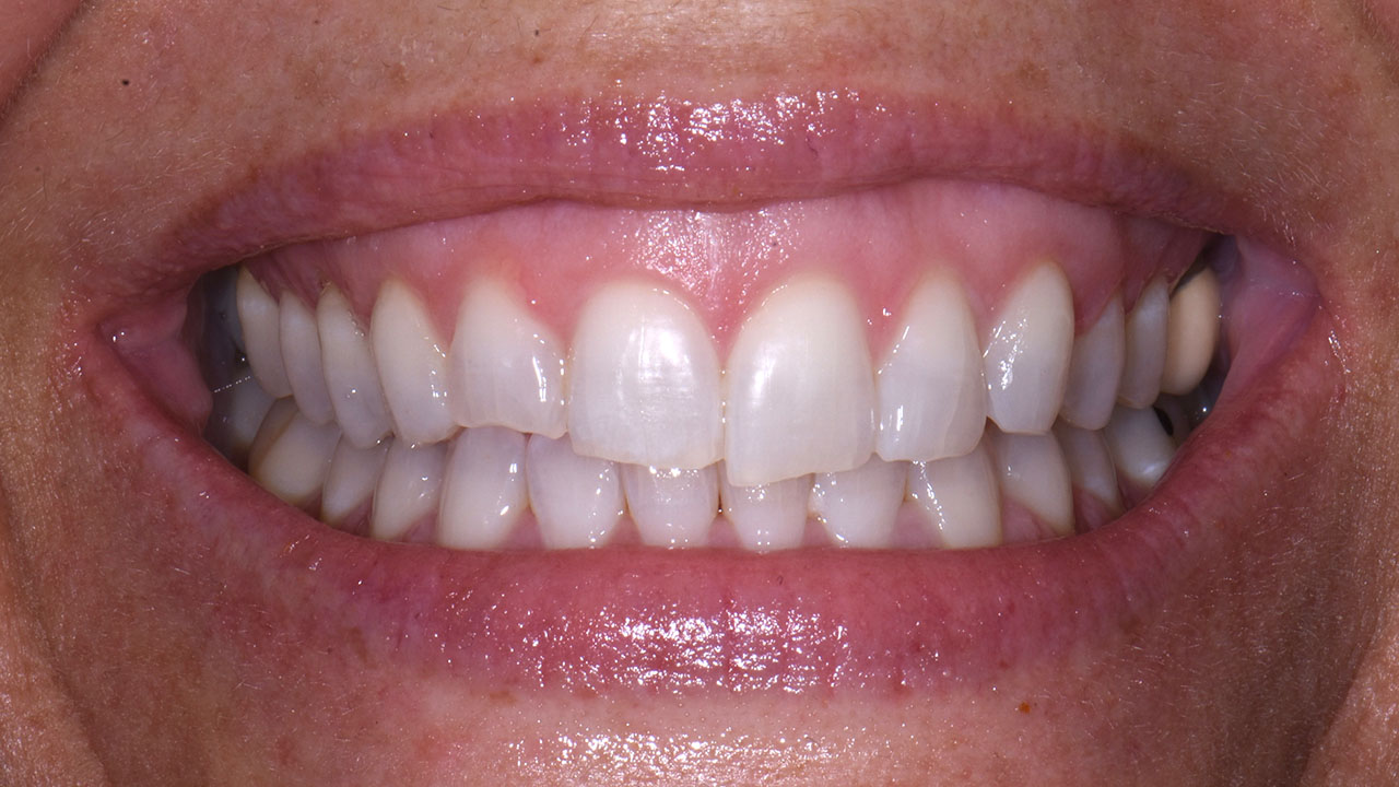 Grandville Mi Bonding Worn Front Teeth Before Close