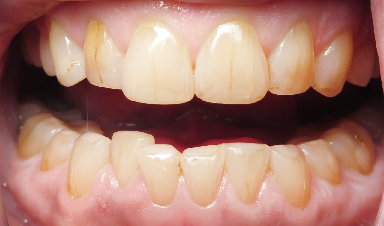 Grandville Mi Bruxism Tooth Wear After Retracted