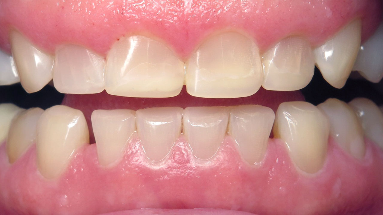 Grandville Mi Bruxism Tooth Wear After Retracted