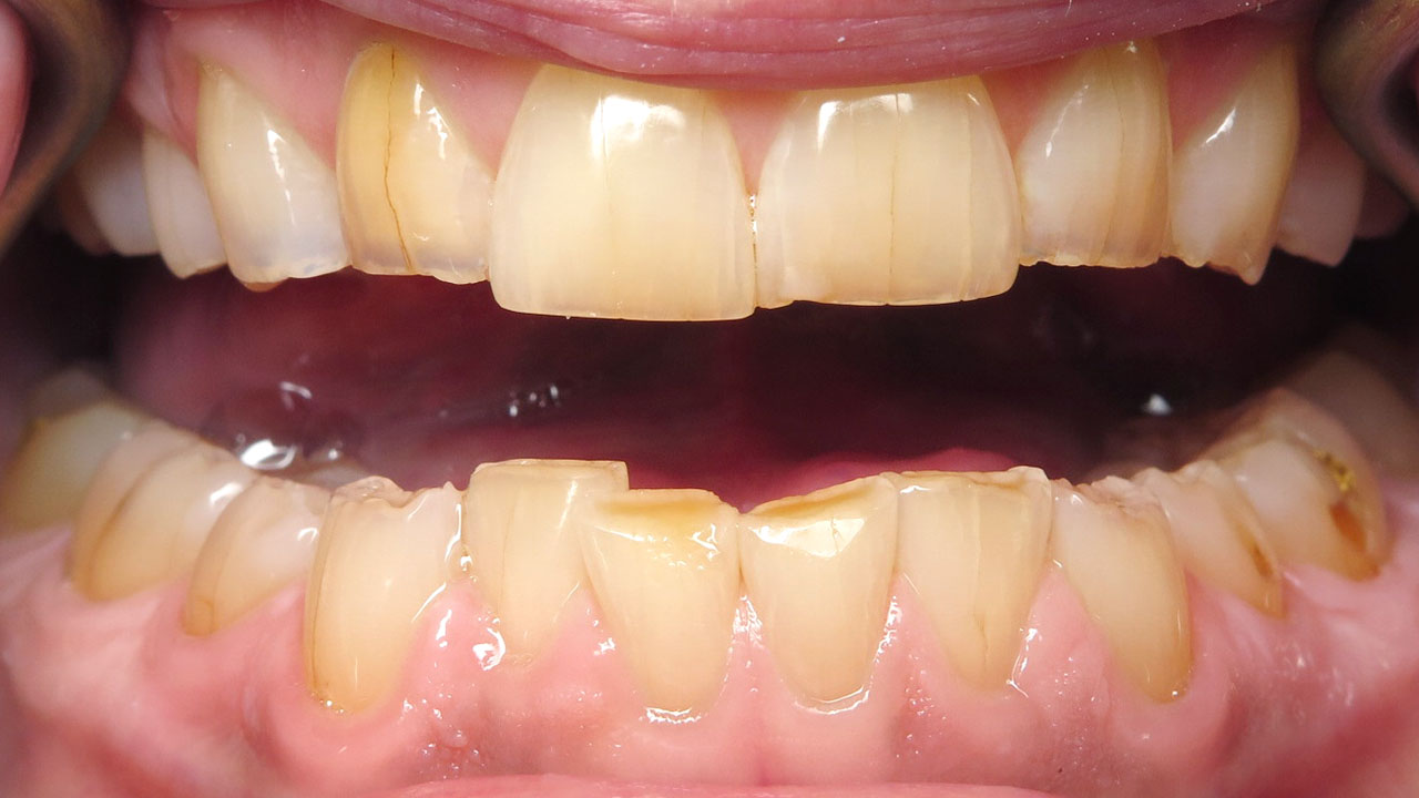 Grandville Mi Bruxism Tooth Wear Before Retracted