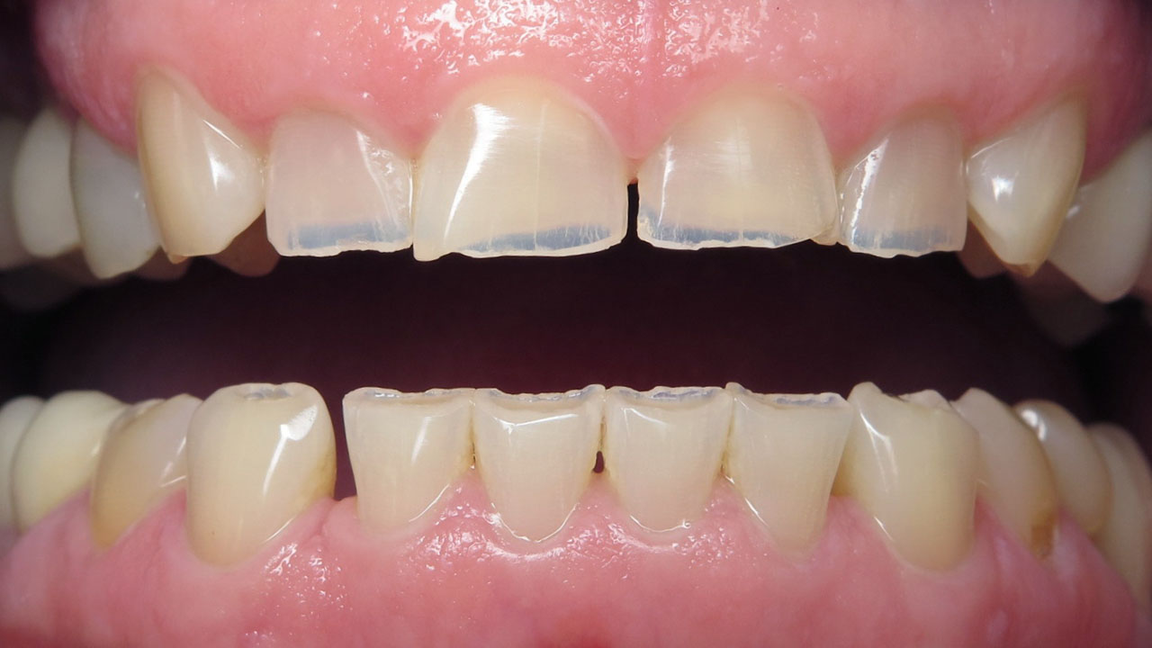 Grandville Mi Bruxism Tooth Wear Before Retracted