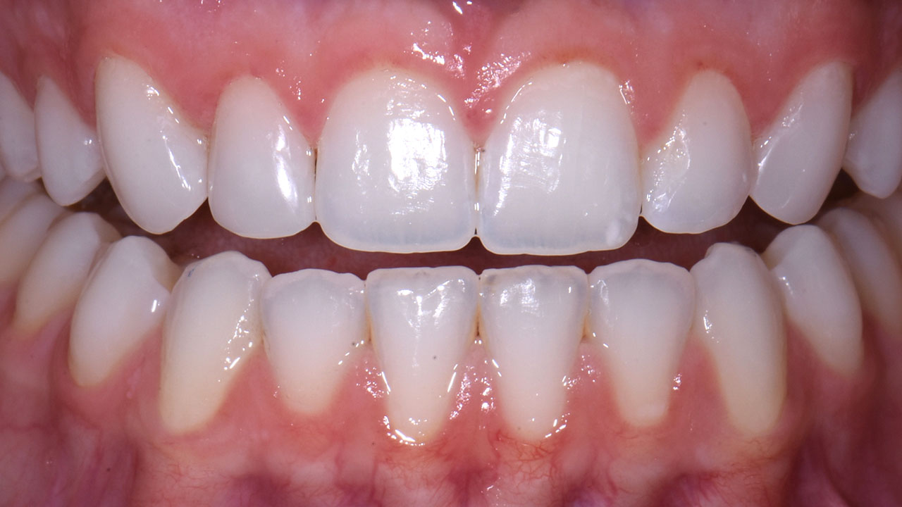 Grandville Mi Conservative Bonding Front Teeth After Retracted