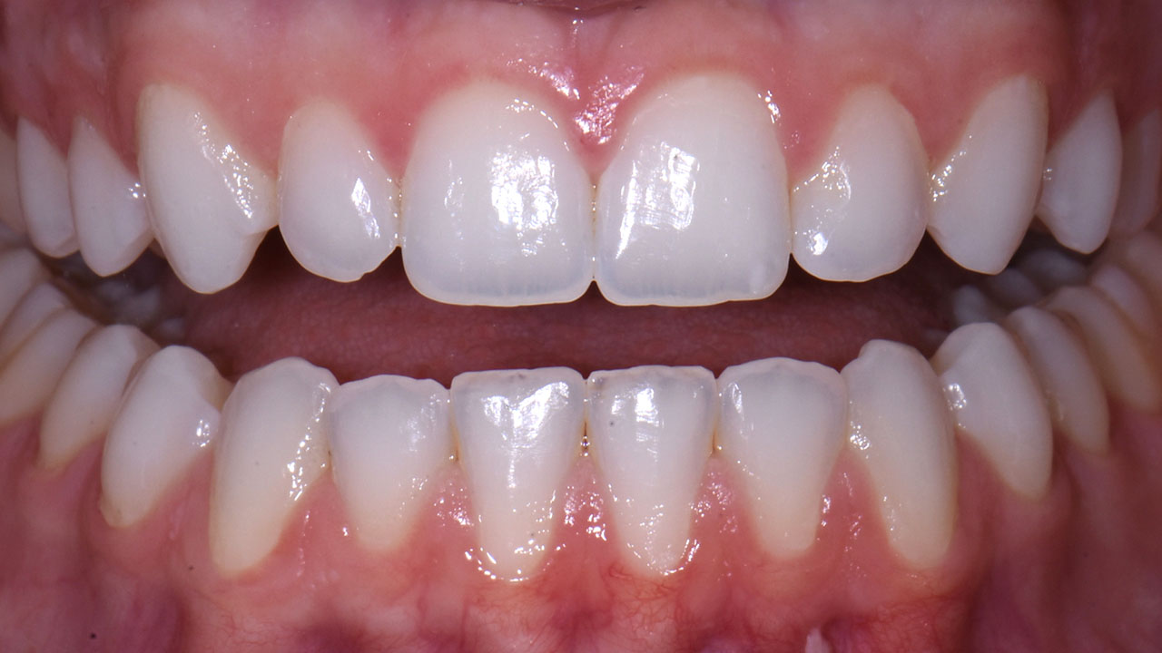 Grandville Mi Conservative Bonding Front Teeth Before Retracted