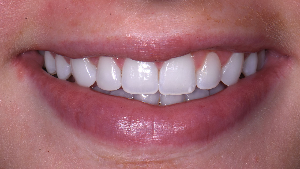 Grandville Mi Cosmetic Bonding After Orthodontics After Smile