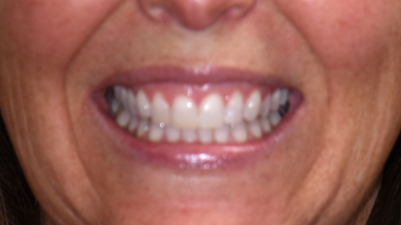 Grandville Mi Cosmetic Bonding After Orthodontics After Smile