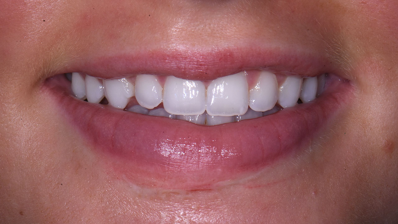 Grandville Mi Cosmetic Bonding After Orthodontics Before Smile