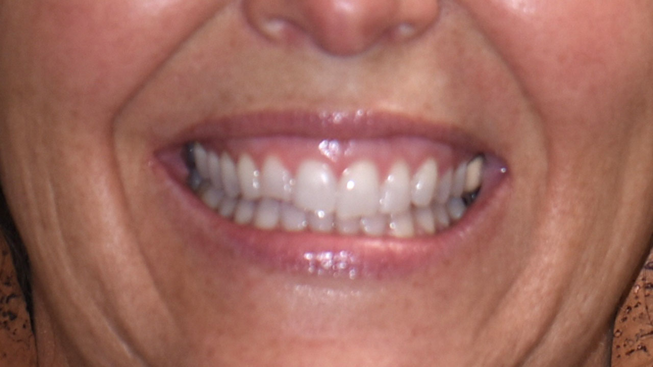 Grandville Mi Cosmetic Bonding After Orthodontics Before Smile