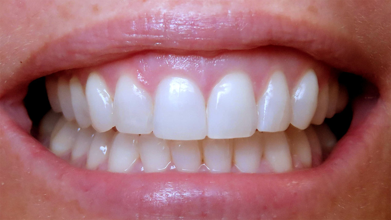 Grandville Mi Cosmetic Bonding Orthodontic Finishing After Retracted