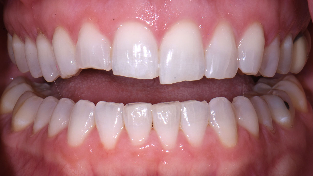 Grandville Mi Cosmetic Bonding Orthodontic Finishing Before Retracted