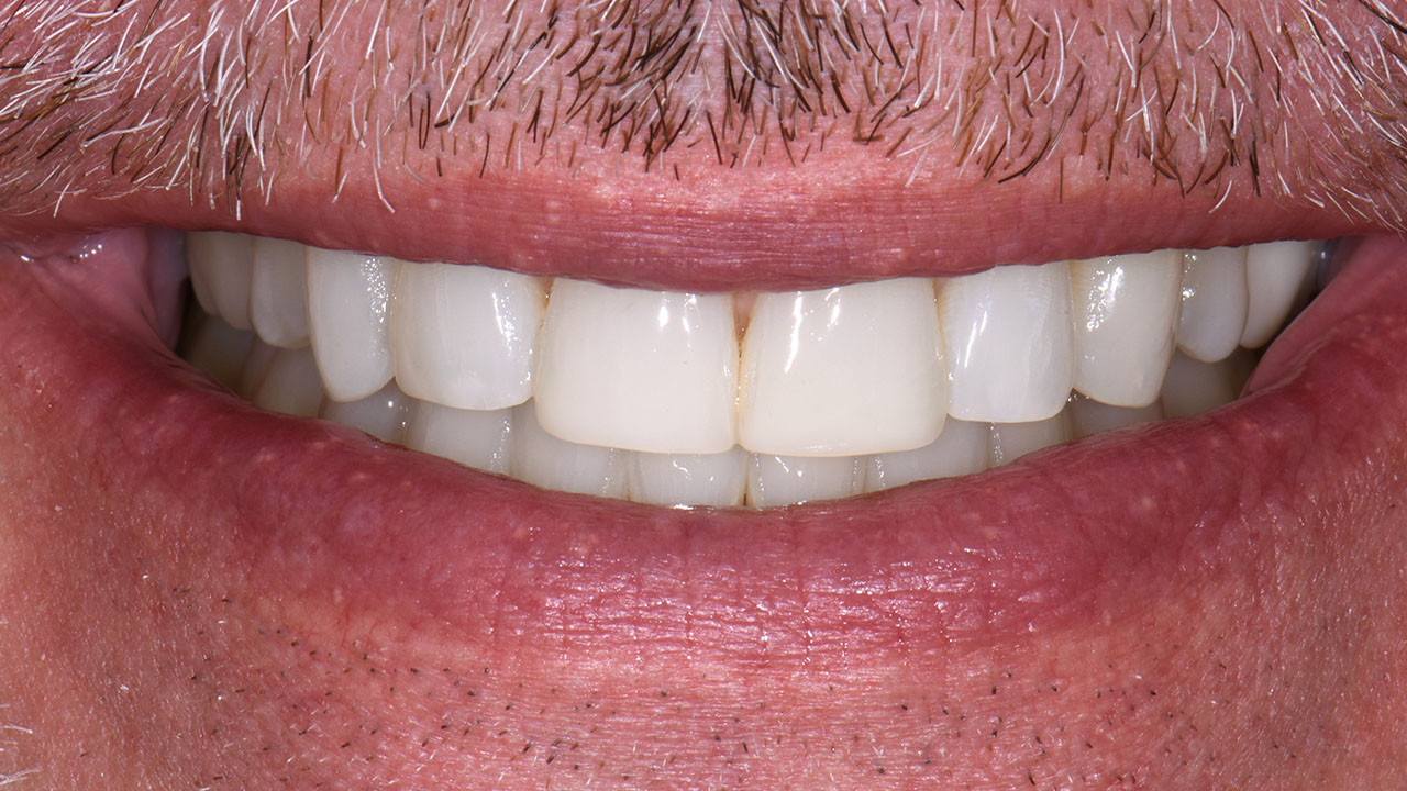 Grandville Mi Cosmetic Bonding Orthodontics After Close Smile