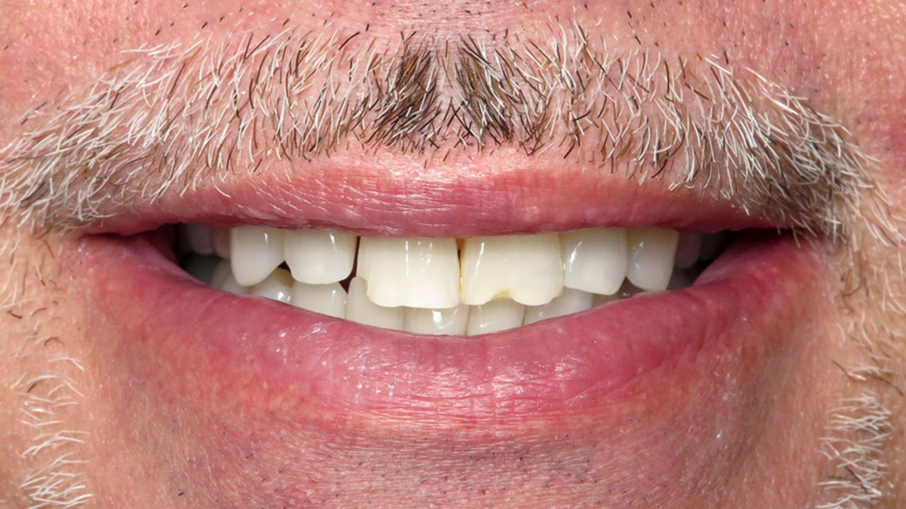 Grandville Mi Cosmetic Bonding Orthodontics Before Close Smile