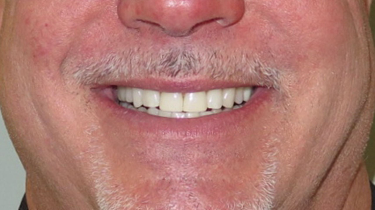 Grandville Mi Dental Bonding Chipped Teeth Gap After Smile