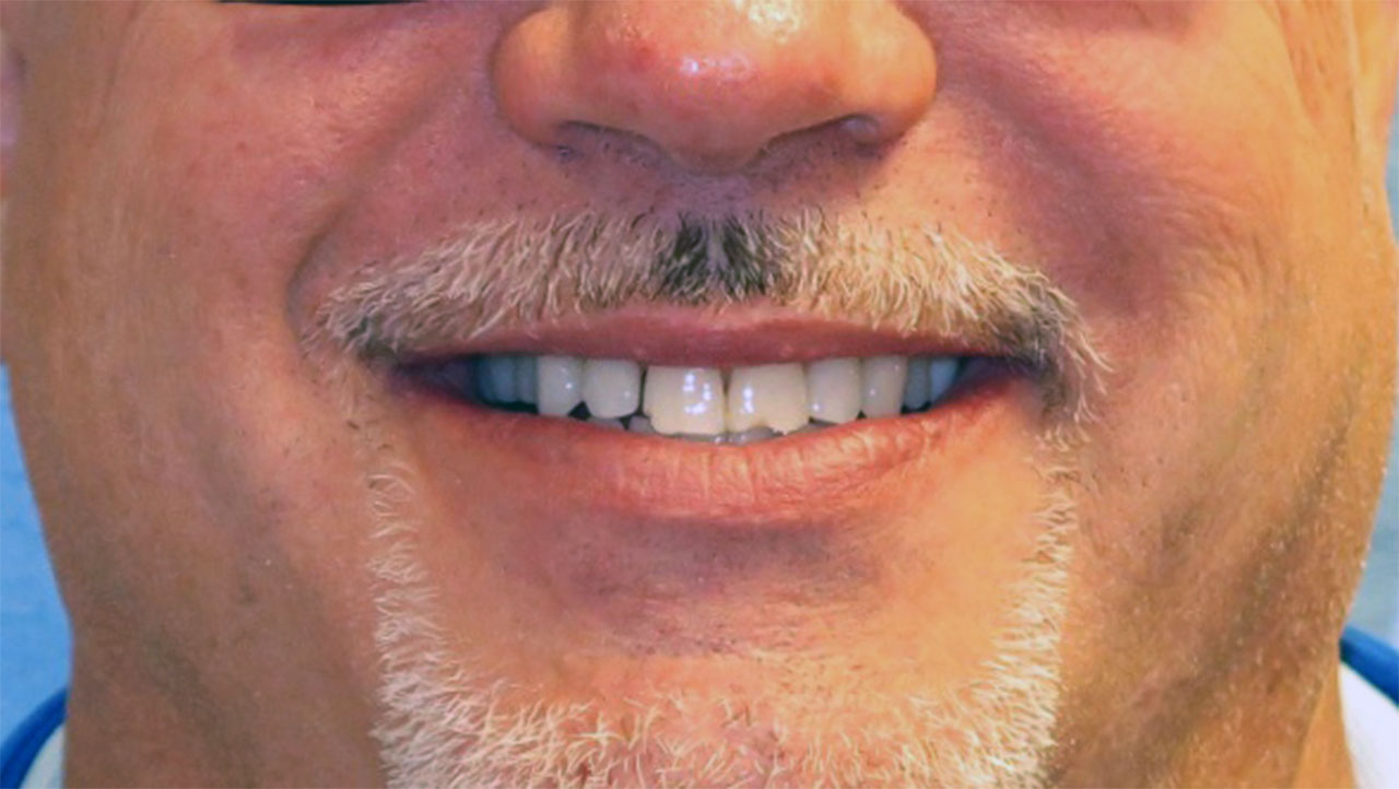 Grandville Mi Dental Bonding Chipped Teeth Gap Before Smile