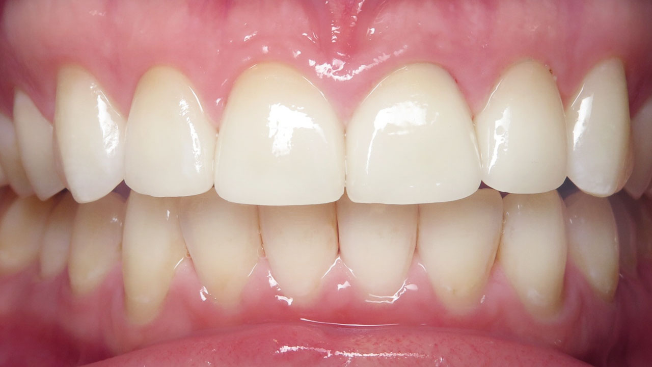 Grandville Mi Dental Crown Dentist After