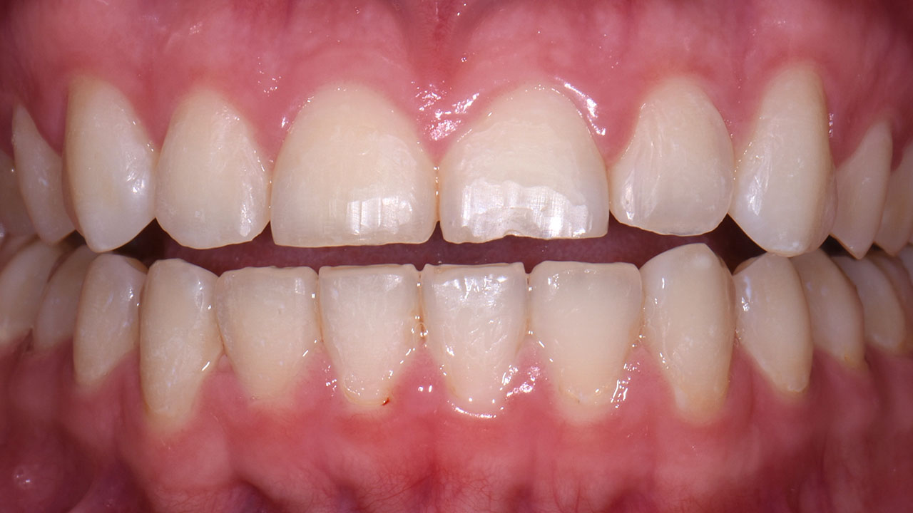 Grandville Mi Dental Crown Dentist Before