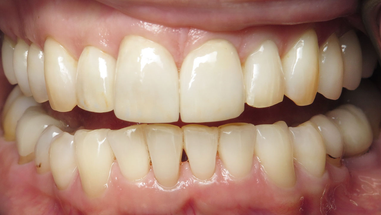 Grandville Mi Porcelain Veneers Dentist After