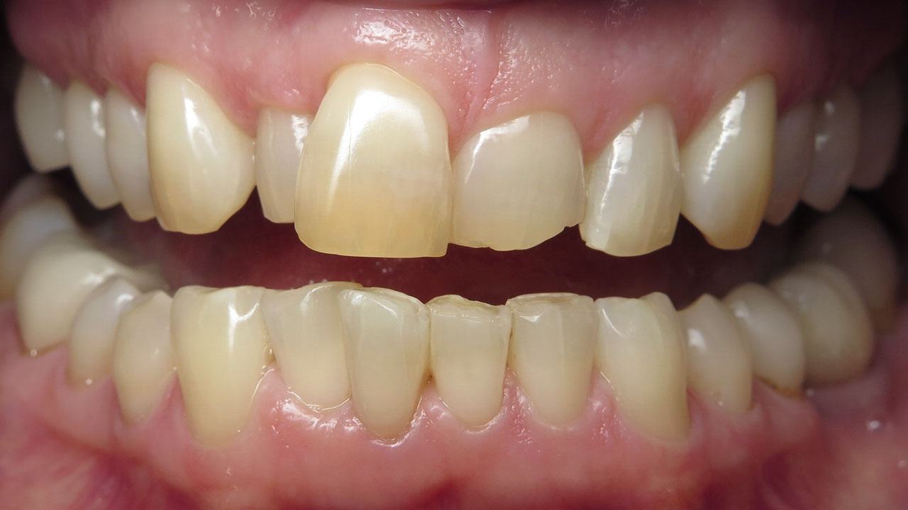 Grandville Mi Porcelain Veneers Dentist Before