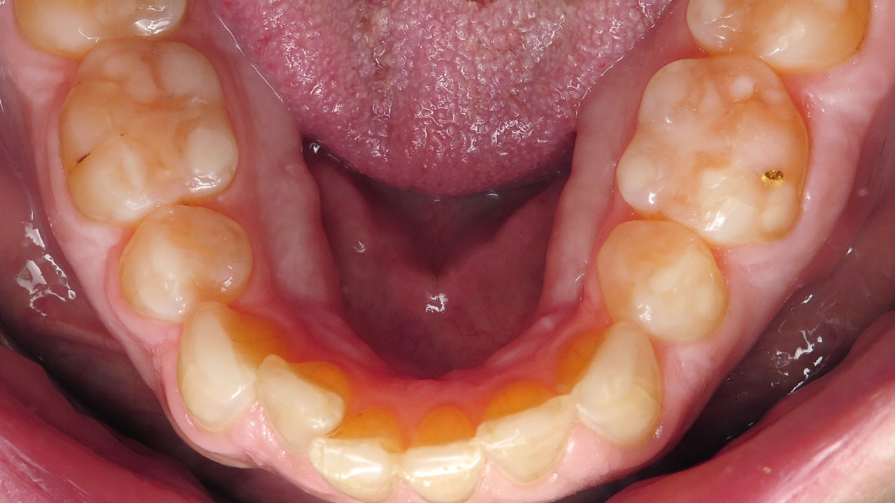 Grandville Mi Tooth Grinding Wear After Lower Occlusal
