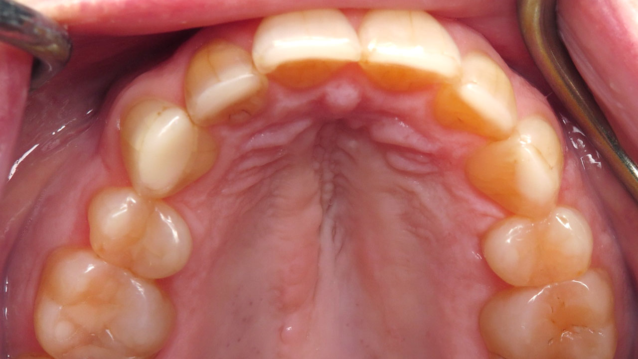 Grandville Mi Tooth Grinding Wear After Upper Occlusal