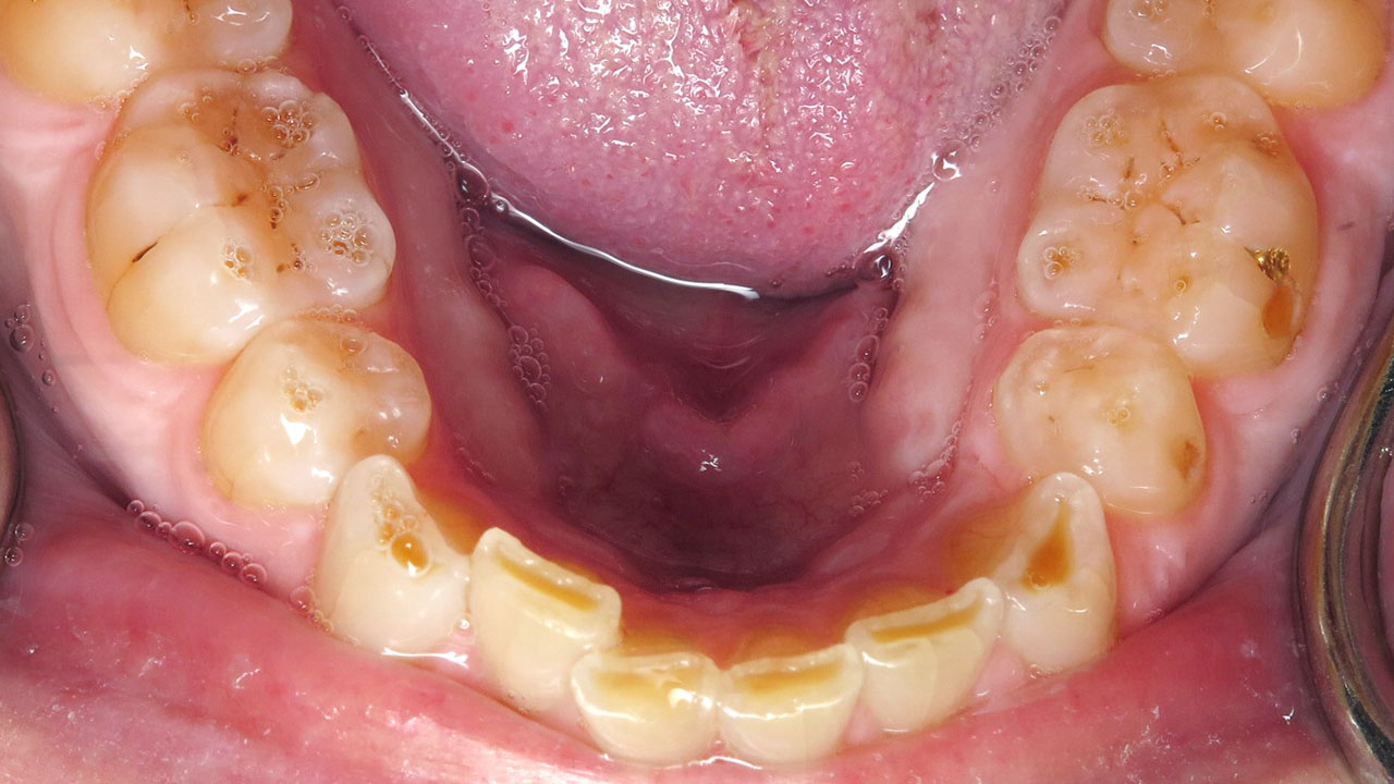 Grandville Mi Worn Front Teeth Before Lower Occlusal