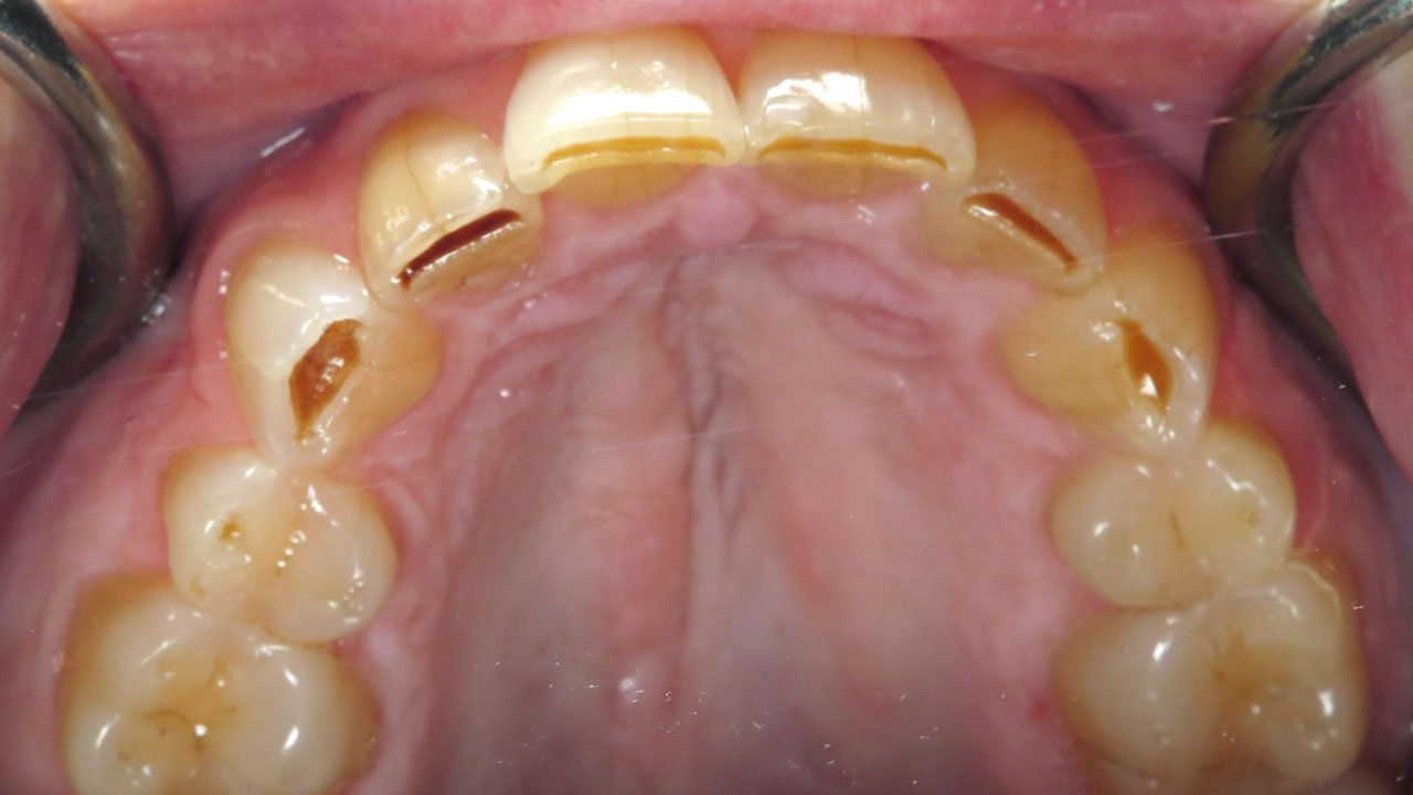 Grandville Mi Worn Front Teeth Before Upper Occlusal