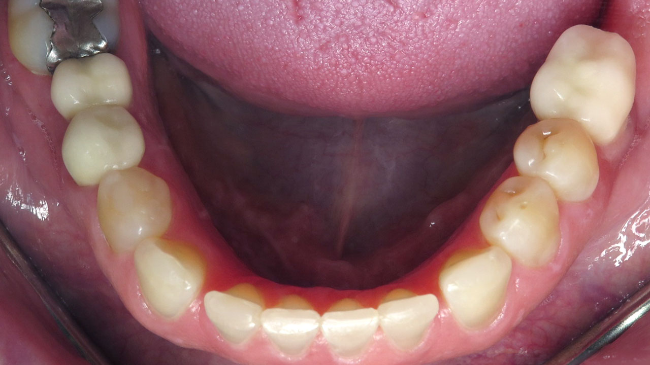 Grandville Mi Worn Front Teeth Bonding After Lower