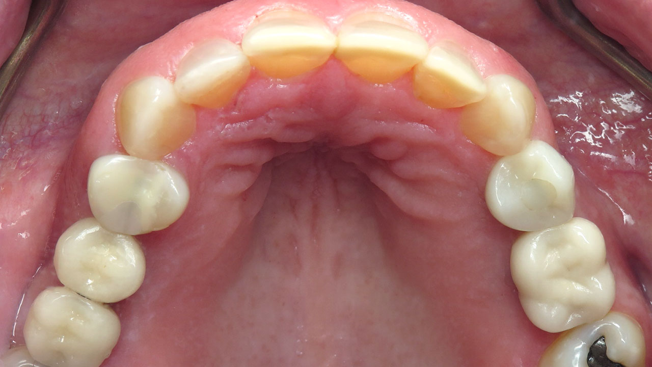 Grandville Mi Worn Front Teeth Bonding After Upper