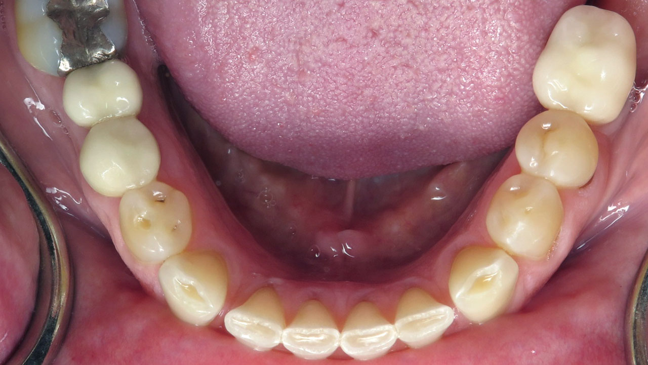 Grandville Mi Worn Front Teeth Bonding Before Lower