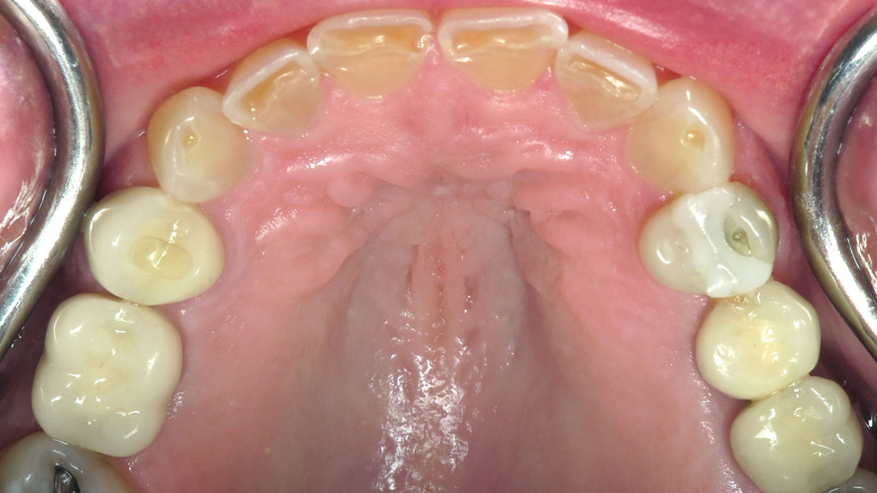 Grandville Mi Worn Front Teeth Bonding Before Upper