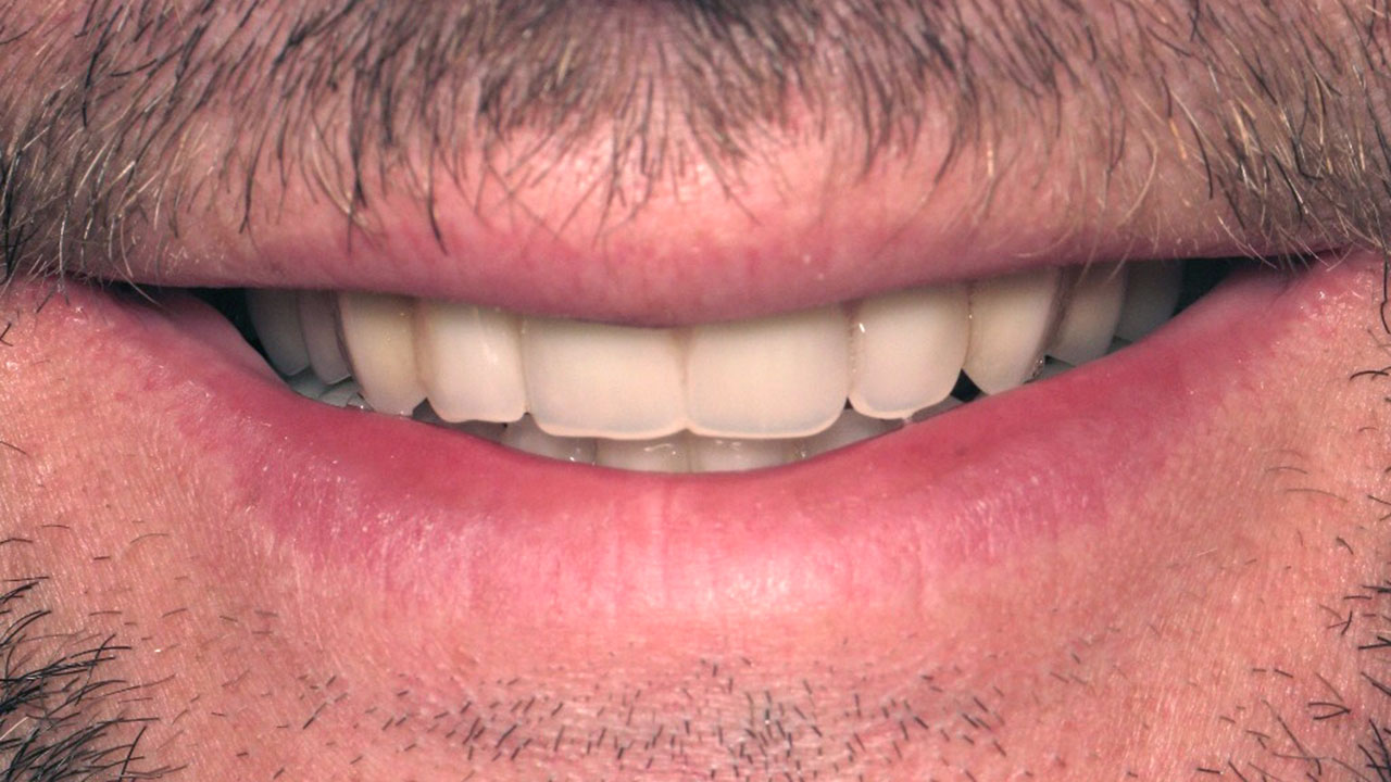 Interim Dentures Progress Close Smile Grandville Mi