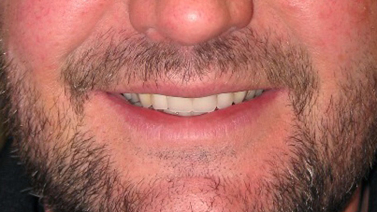 Interim Dentures Progress Smile Grandville Mi