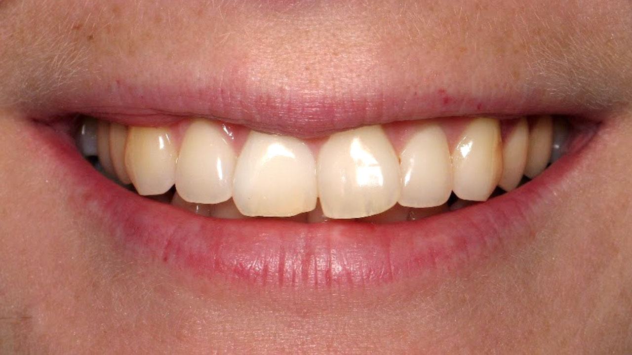 Internal Whitening Dark Front Tooth After Grandville Mi