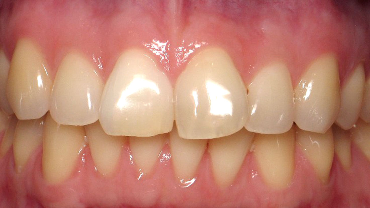 Internal Whitening Dark Front Tooth After West Michigan