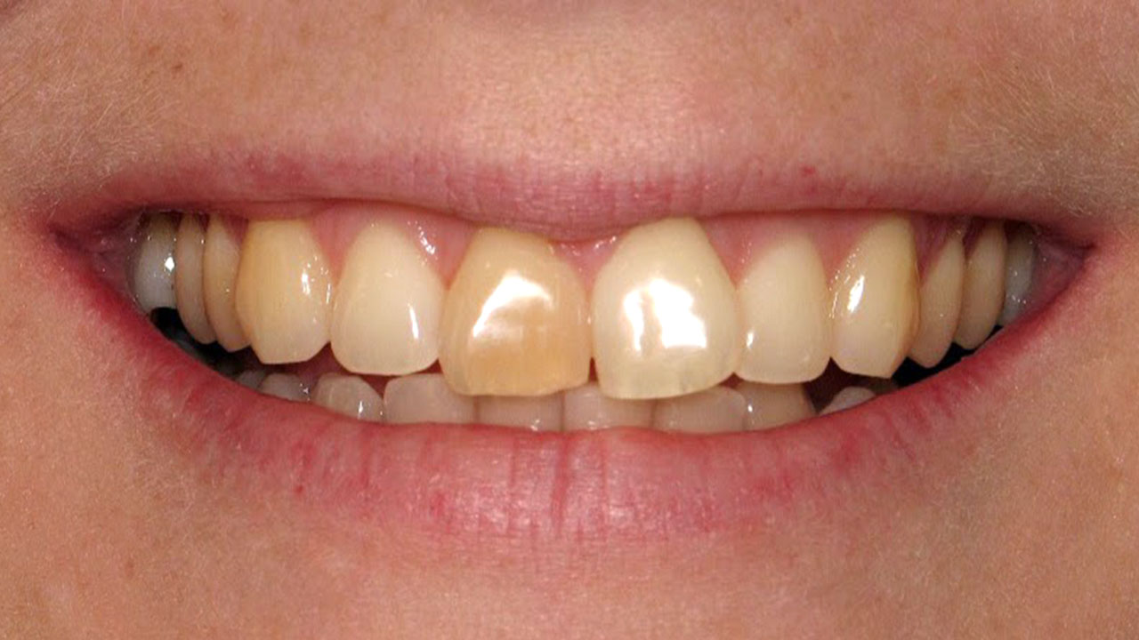 Internal Whitening Dark Front Tooth Before Grandville Mi