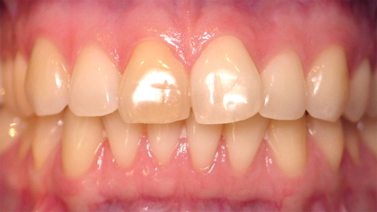 Internal Whitening Dark Front Tooth Before West Michigan