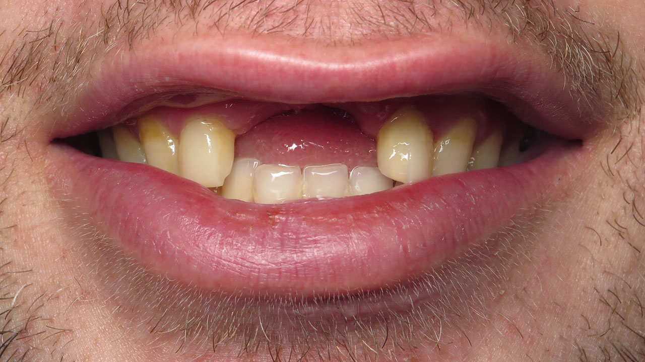 Missing Front Teeth Trauma Close Up Before Grandville Mi