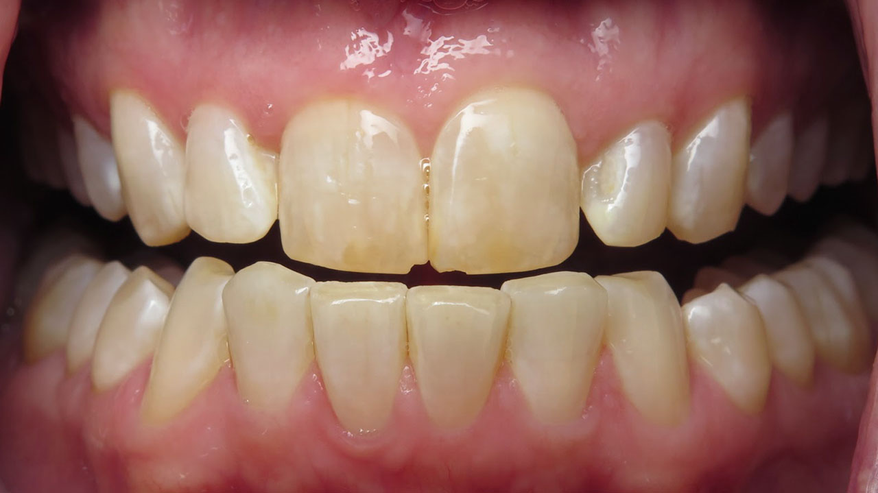 Odontoplasty Chipped Front Teeth Before Dentist Near You