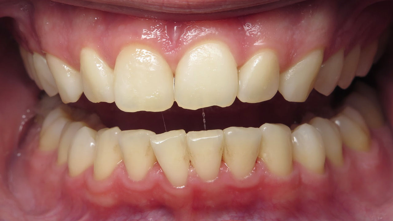 Odontoplasty Chipped Front Teeth Before West Michigan Dentist