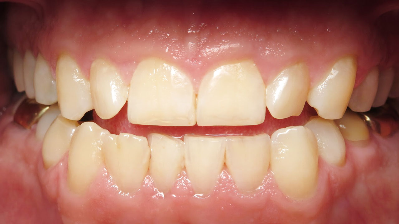 Odontoplasty Chipped Front Teeth Close After Case1