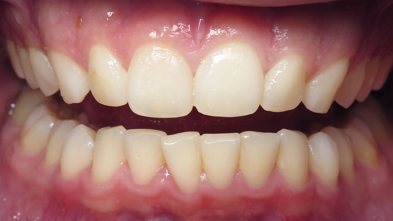 Odontoplasty Chipped Front Teeth Close After Case2