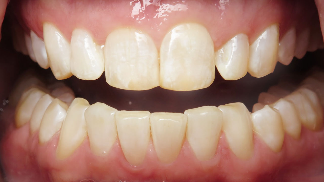 Odontoplasty Chipped Front Teeth Close After Case3