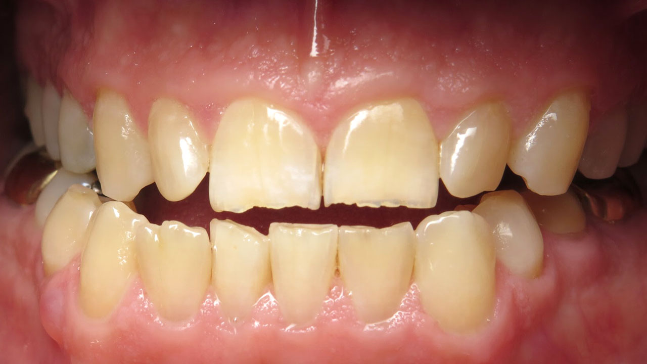 Odontoplasty Chipped Front Teeth Close Before Case1