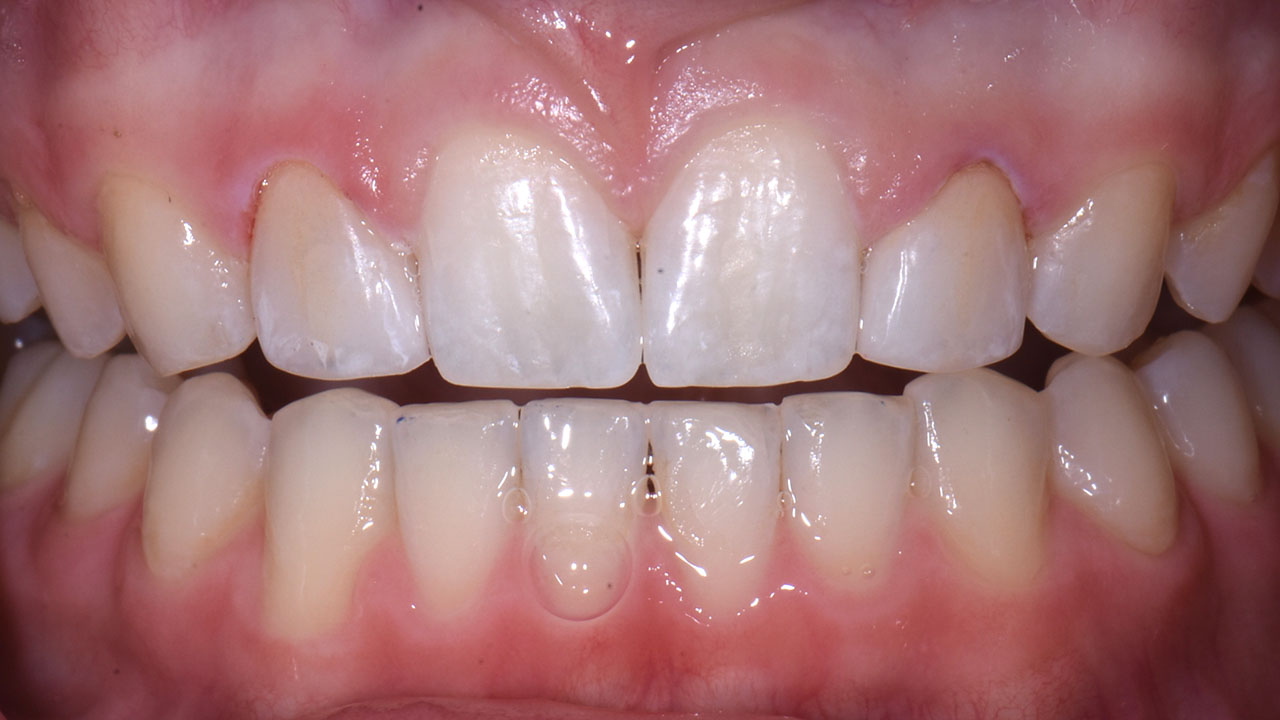 Peg Lateral Close After Resin Veneers Grandville Mi