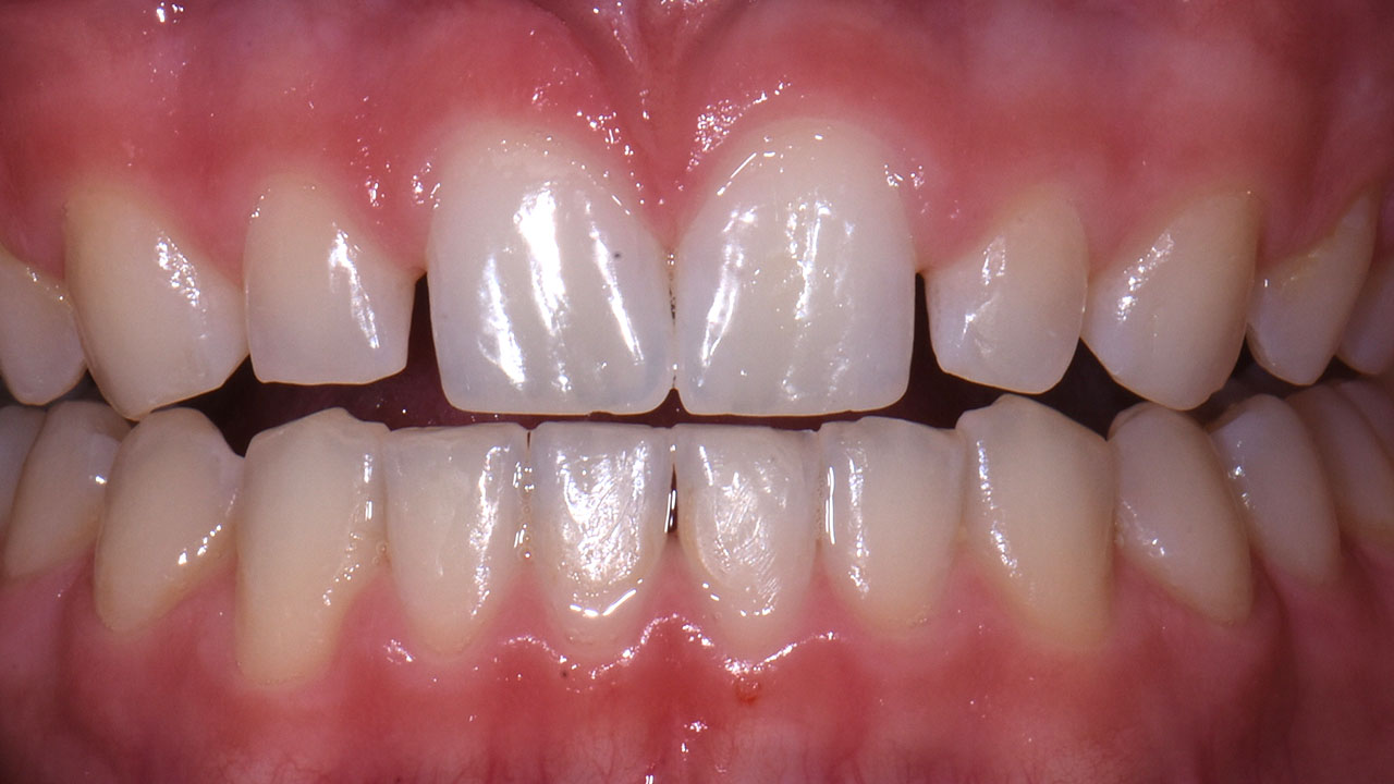 Peg Lateral Close Before Resin Veneers Grandville Mi