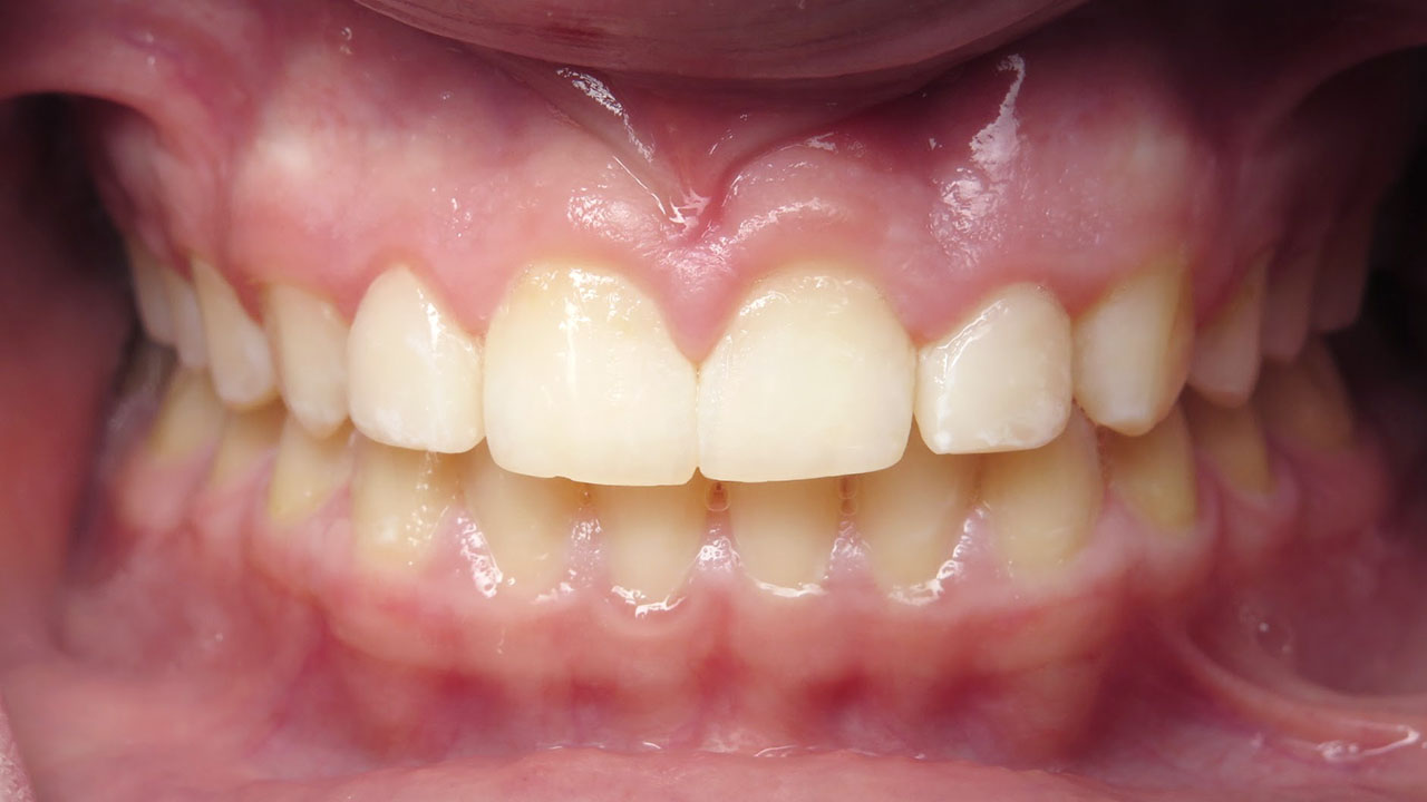 Peg Lateral Small Tooth After Resin Veneer Grandville Mi