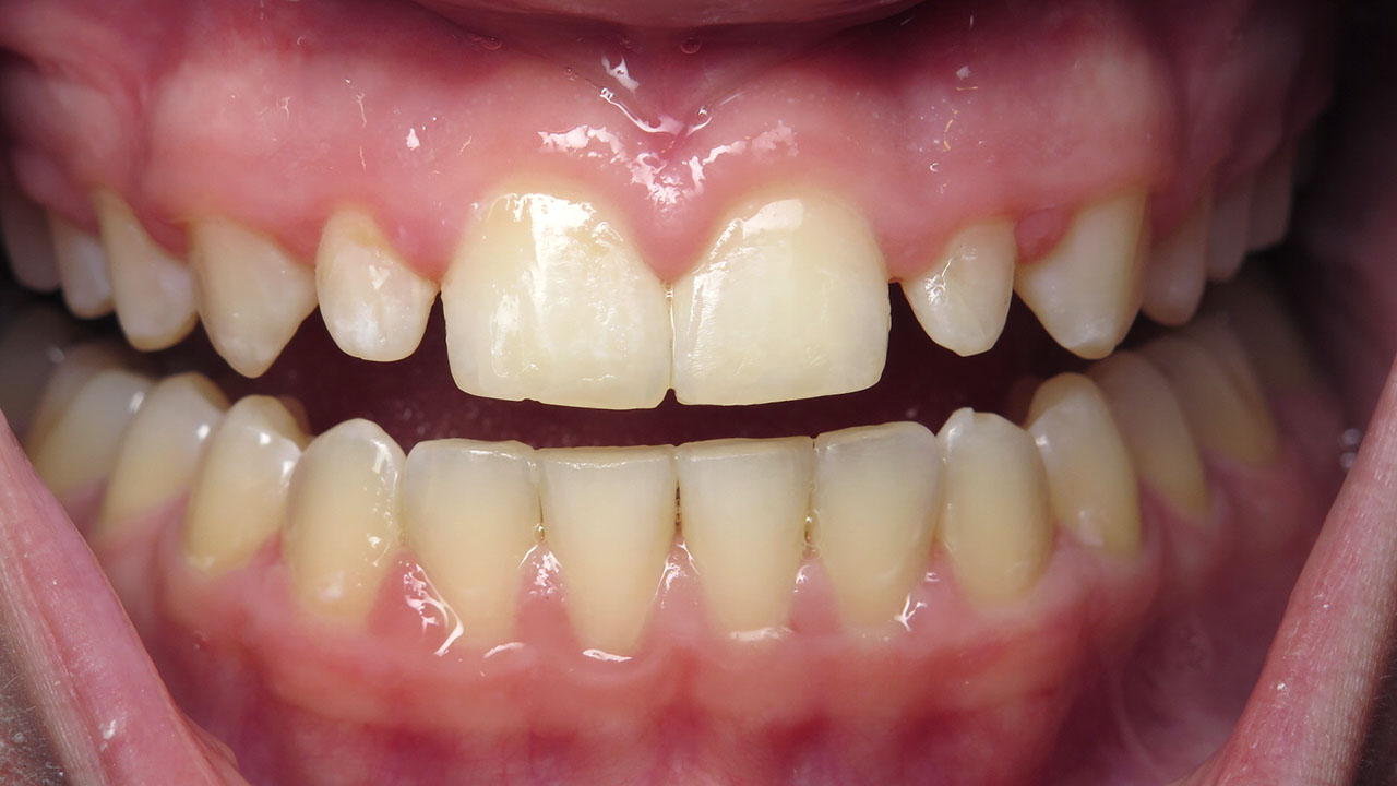 Peg Lateral Small Tooth Before Resin Veneer Grandville Mi