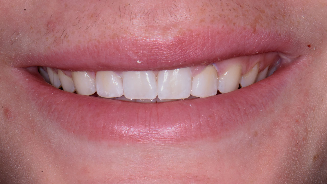 Peg Lateral Smile After Restoration Grandville Mi