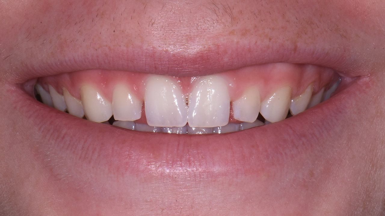 Peg Lateral Smile Before Restoration Grandville Mi