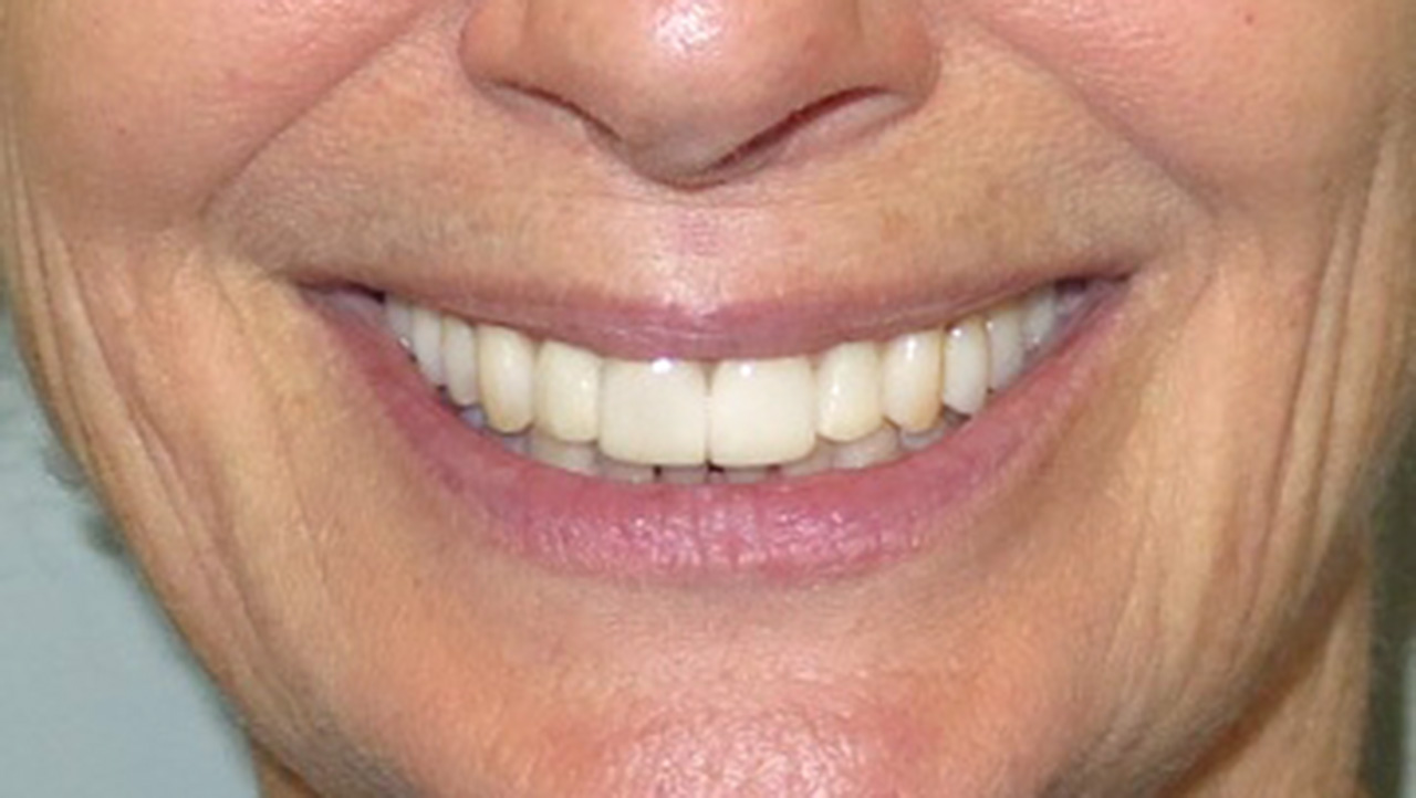 Porcelain Veneers Dentist Grandville Mi After