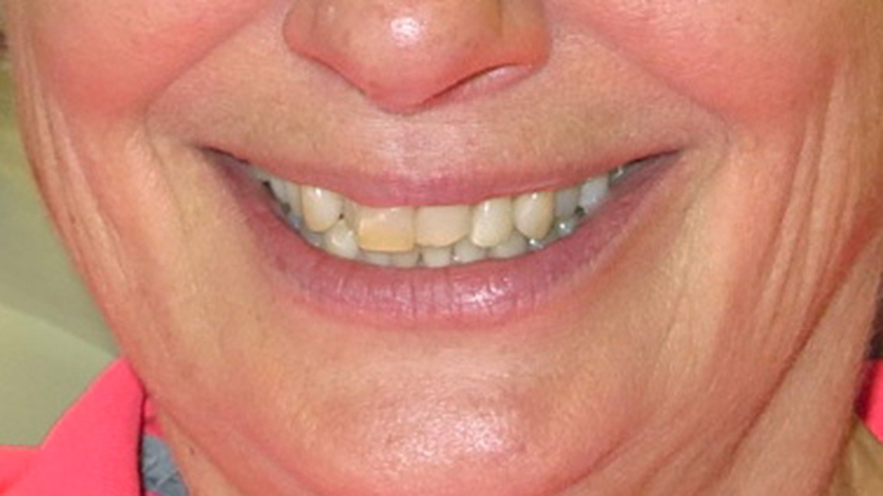Porcelain Veneers Dentist Grandville Mi Before